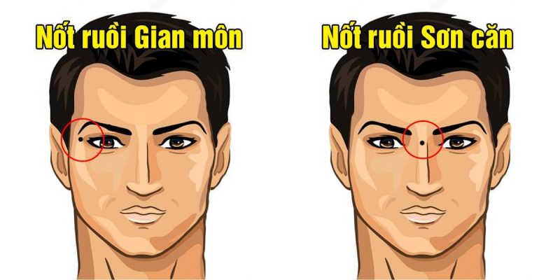 Nốt ruồi xấu ở sơn căn khuôn mặt nam