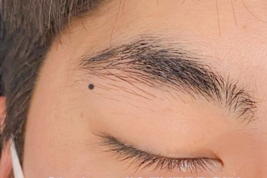 Các nốt ruồi nên cân nhắc xóa