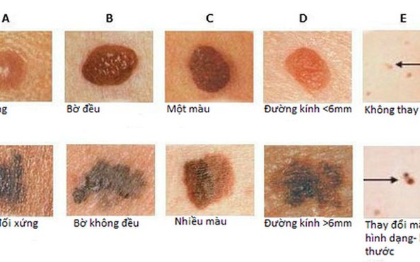Nốt ruồi quanh miệng ở nam giới