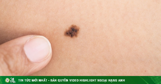 Dấu hiệu nhận biết nốt ruồi nguy hiểm