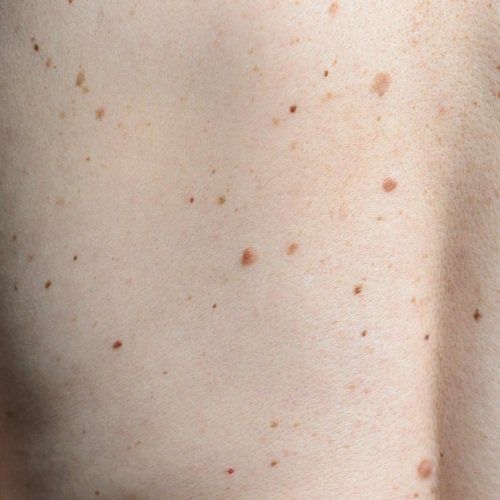 Nhiều nốt ruồi son trên vùng da