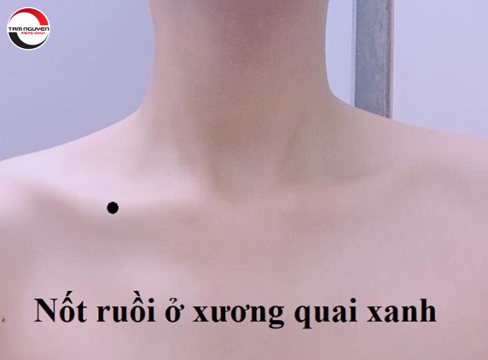 Tướng xương quai xanh và nốt ruồi