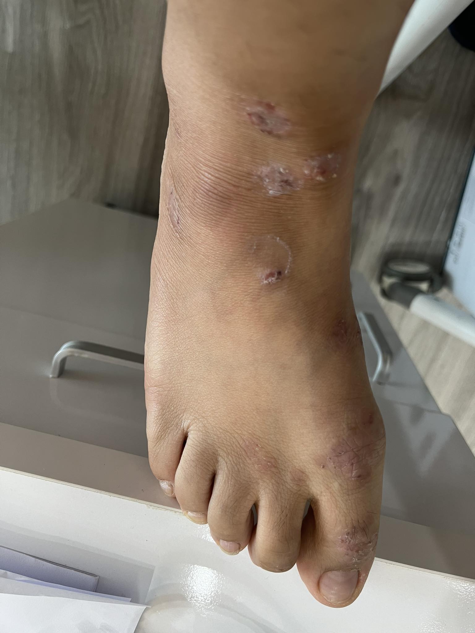 Hình ảnh người bị ngứa chân