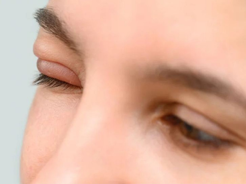 Người bị lẹo mắt cần chăm sóc đúng cách