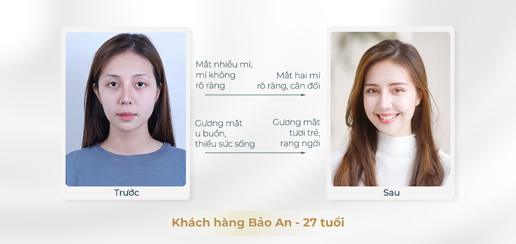 Đôi mắt hai mí tự nhiên trẻ trung