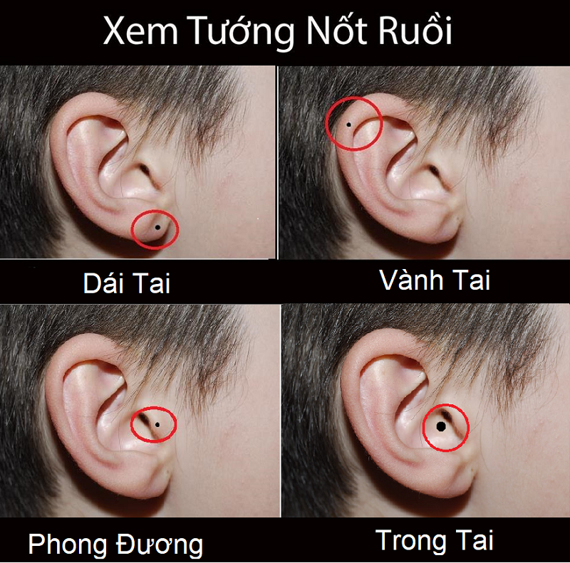 Các vị trí nốt ruồi ở tai phải nam