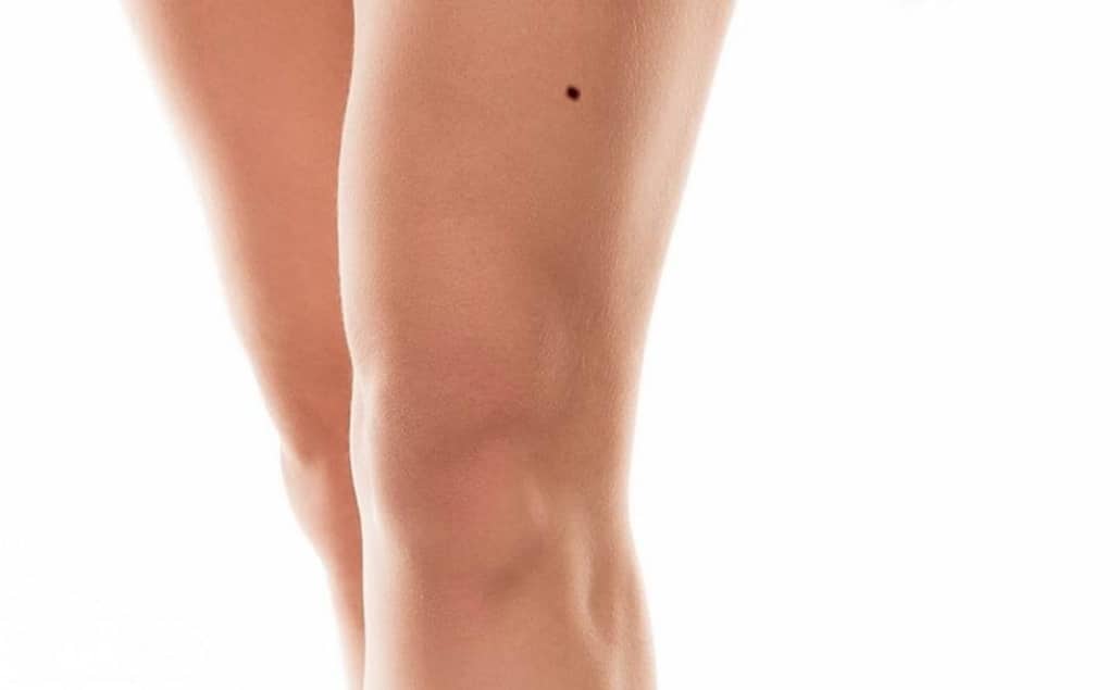 Nốt ruồi trên đùi gần đầu gối