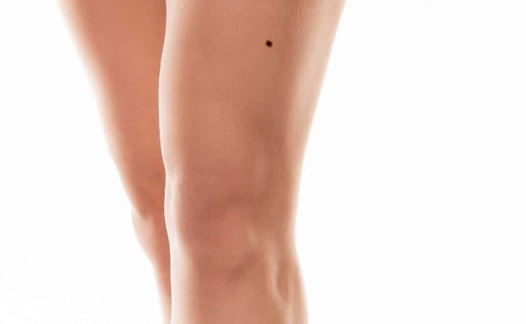 Nốt ruồi trên đùi theo nhân tướng