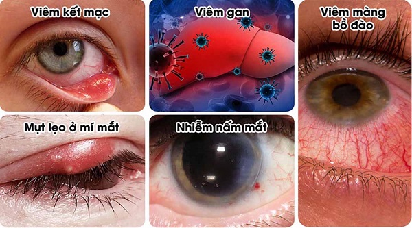 Nguyên nhân mắt phải giật