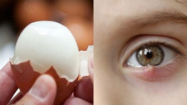 Cận cảnh mụn lẹo xuất hiện ở mắt