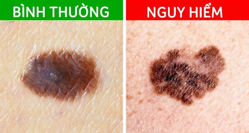 Nhận diện nốt ruồi ác tính