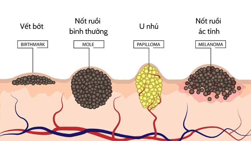 Cách nhận biết nốt ruồi ác tính