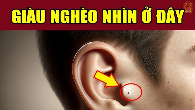Hình ảnh nốt ruồi ở vành tai