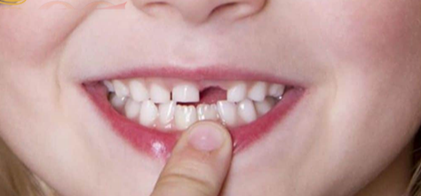 Nằm mơ thấy rụng răng hàm trên đánh đề con gì