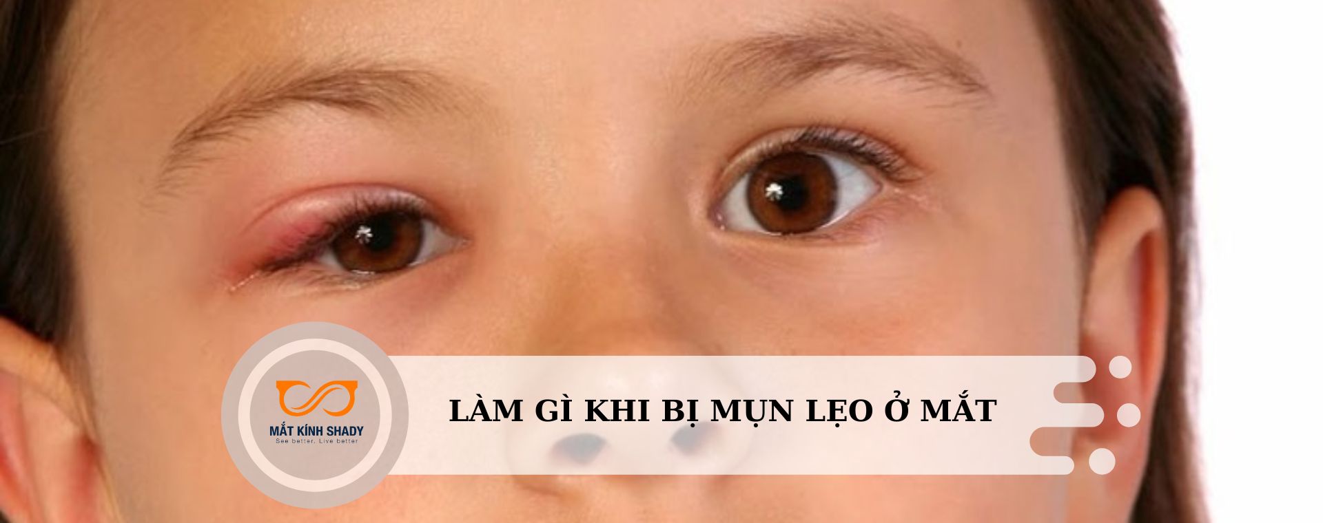 Bị mụn lẹo ở mắt phải làm gì