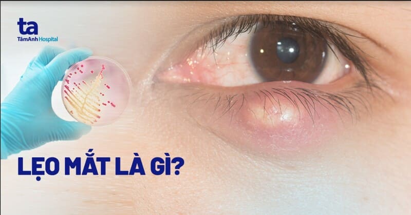 Mắt nổi lẹo ở mí trên