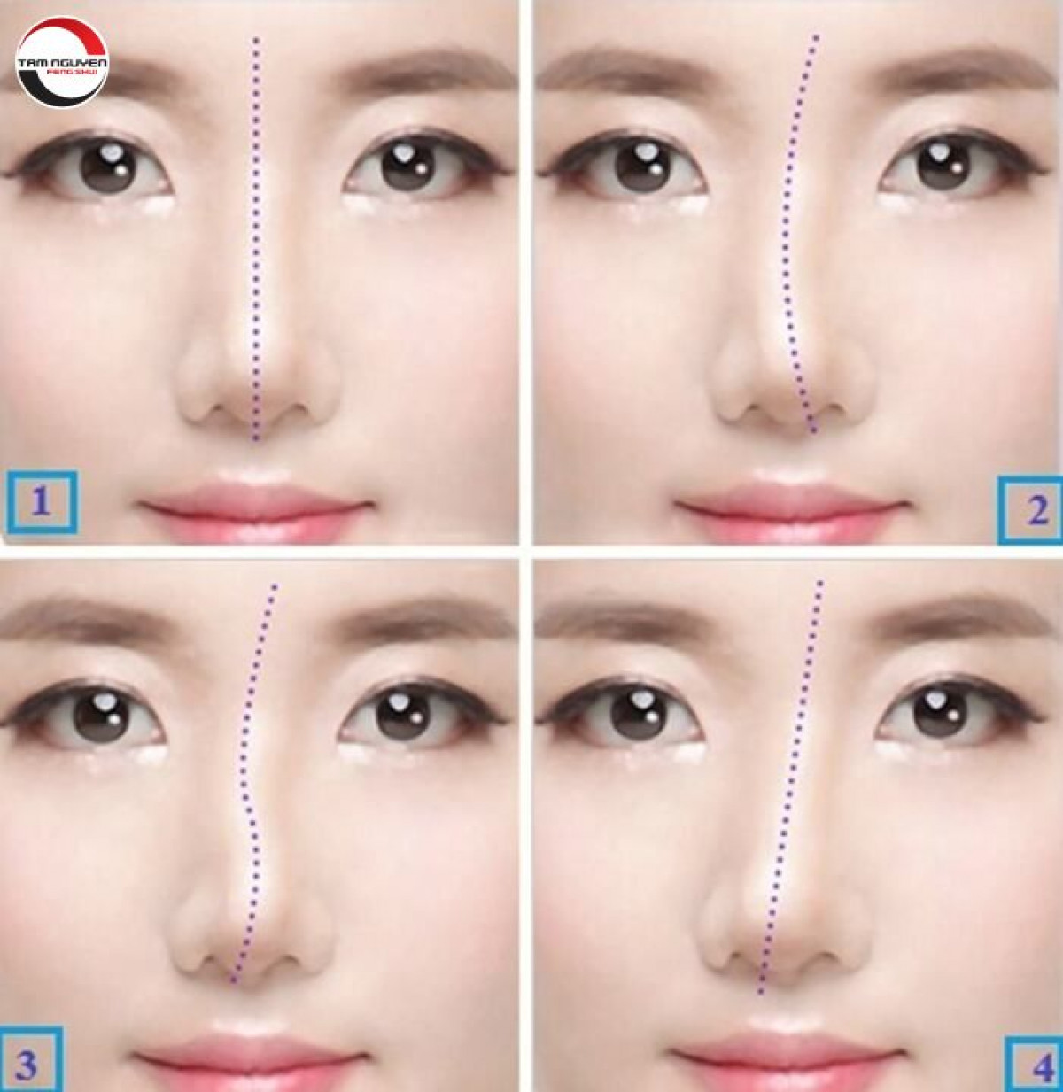 Hình ảnh mũi lệch đặc trưng