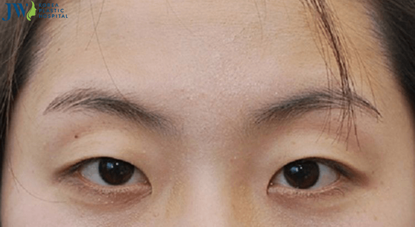 Đặc điểm mắt một mí thường gặp