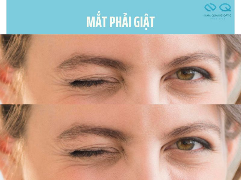 Hình ảnh hiện tượng mắt phải giật