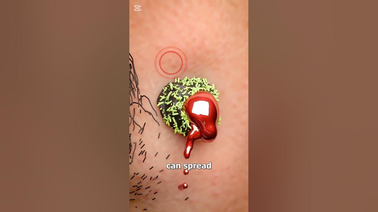 Nốt ruồi gần miệng ở người lớn
