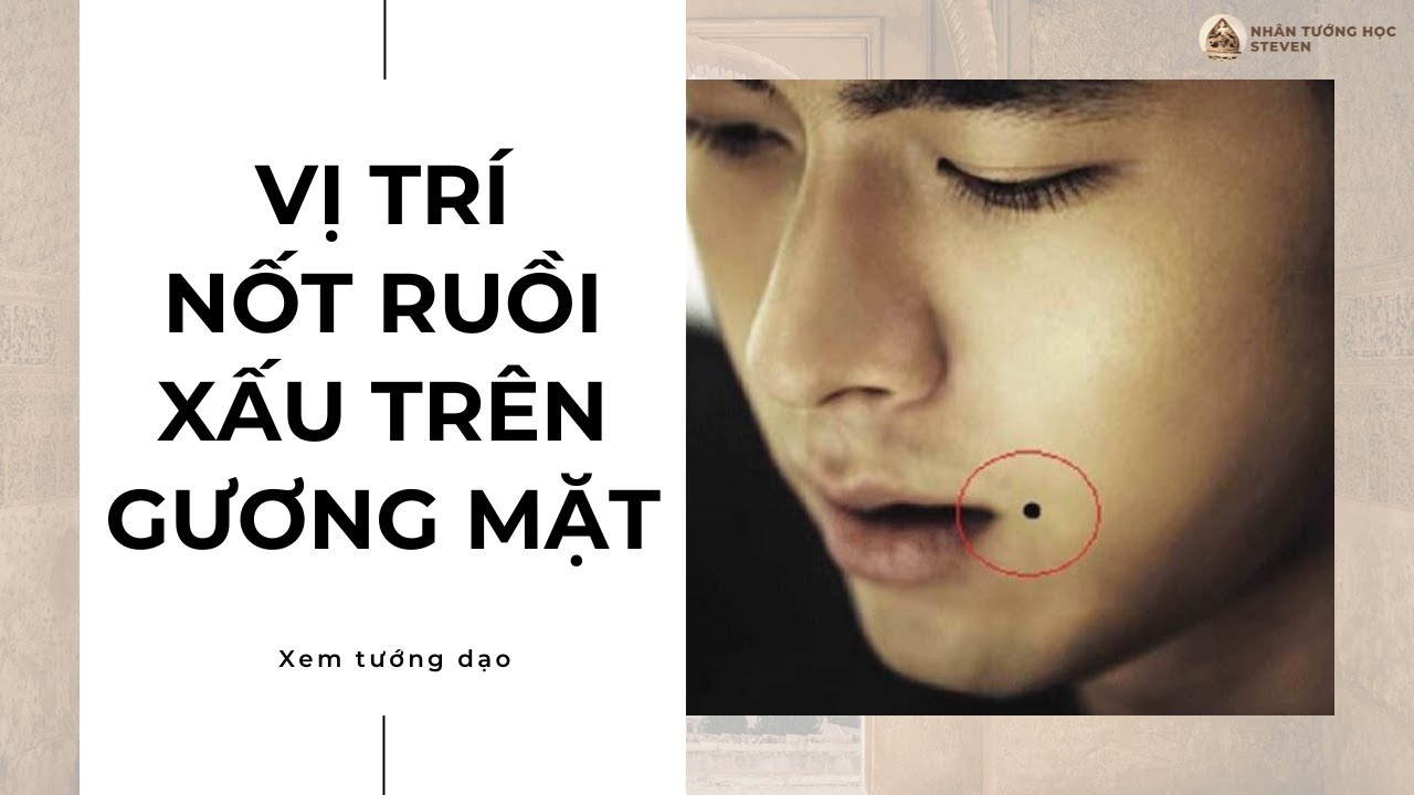 Các vị trí nốt ruồi không tốt trên mặt