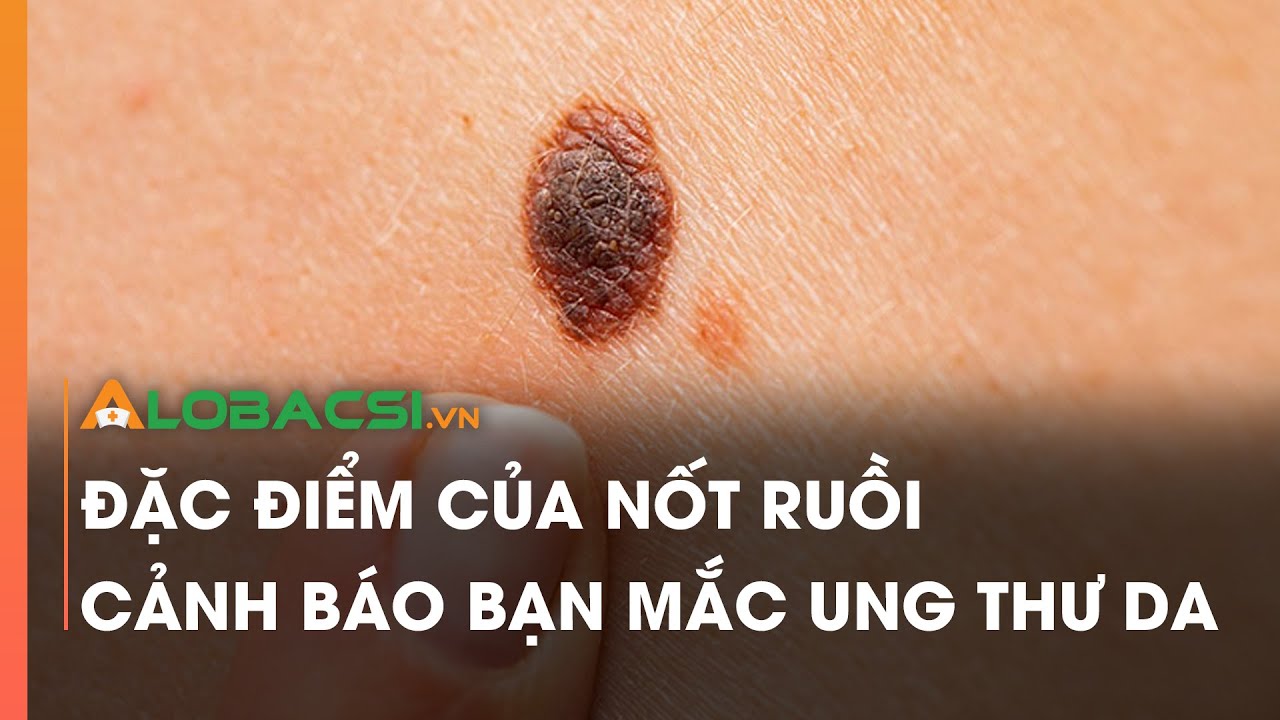 Nốt ruồi đỏ trên làn da người