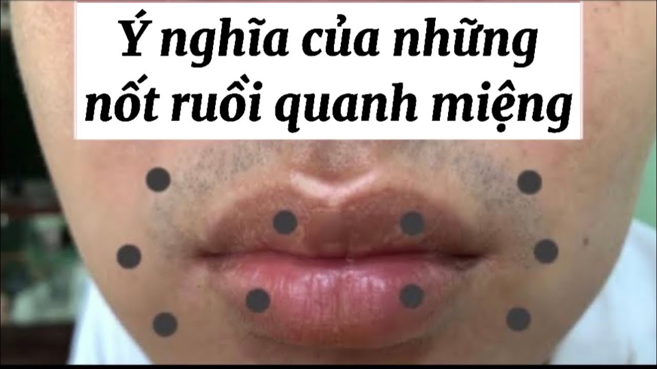 Nốt ruồi dưới môi và quanh miệng