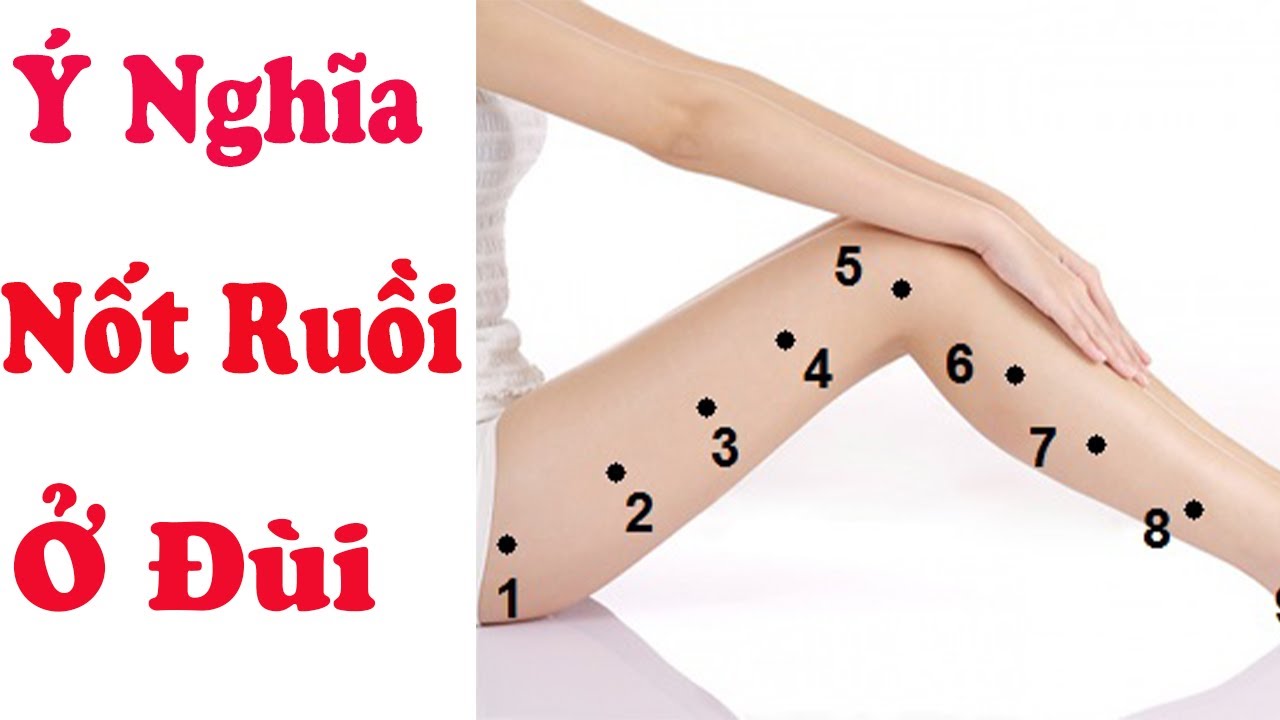 Hình minh họa nốt ruồi ở đùi