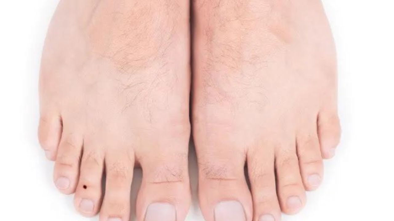 Nốt ruồi ở ngón chân trỏ