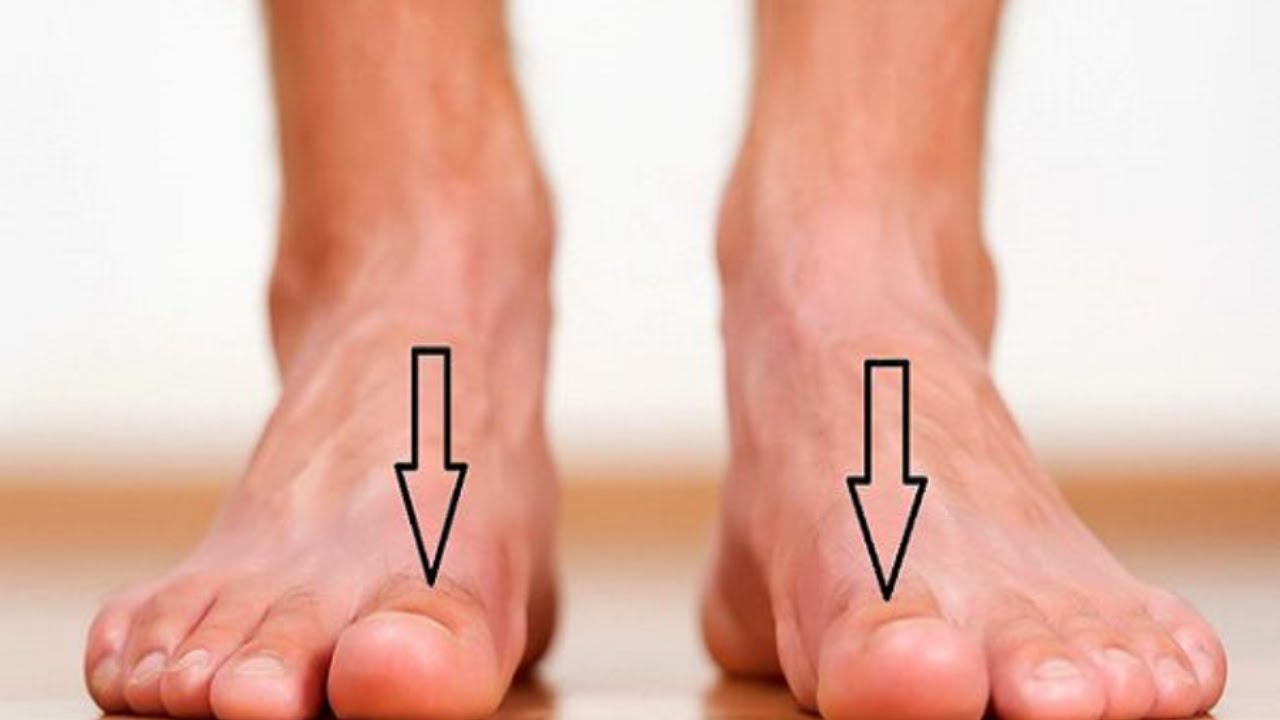 Nốt ruồi ở ngón chân cái nam giới