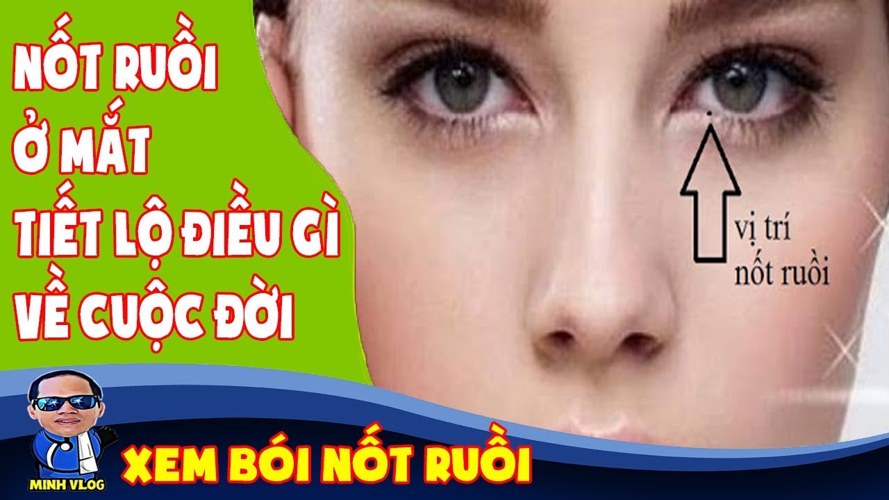 Nốt ruồi ở khóe mắt bên trái