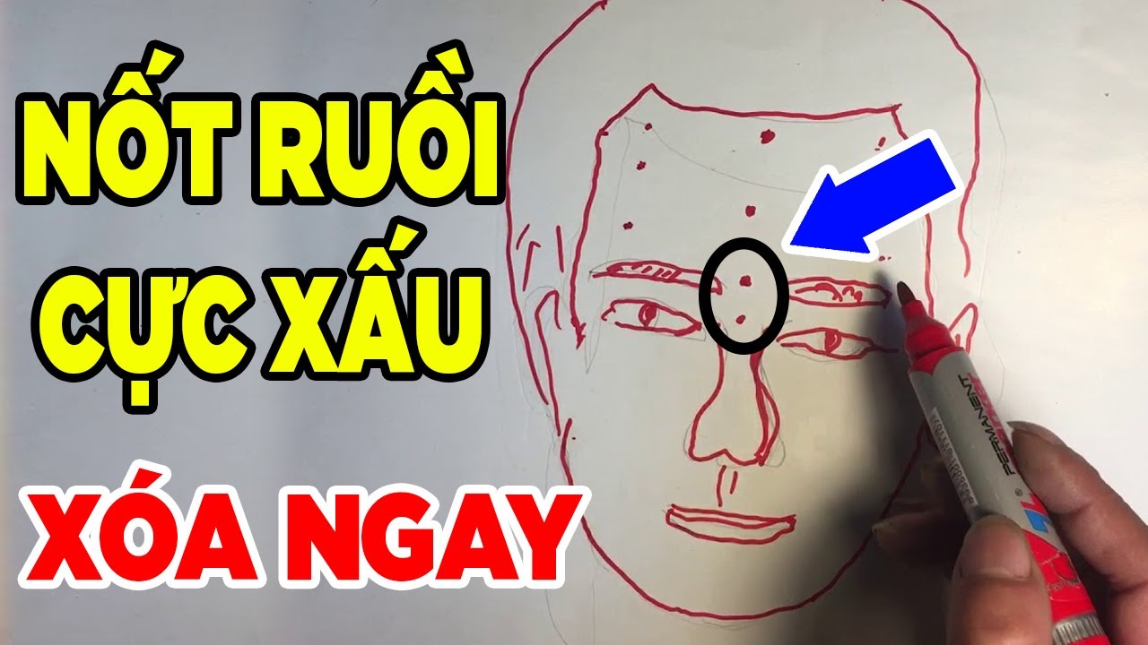 Nốt ruồi xấu trên mặt đàn ông