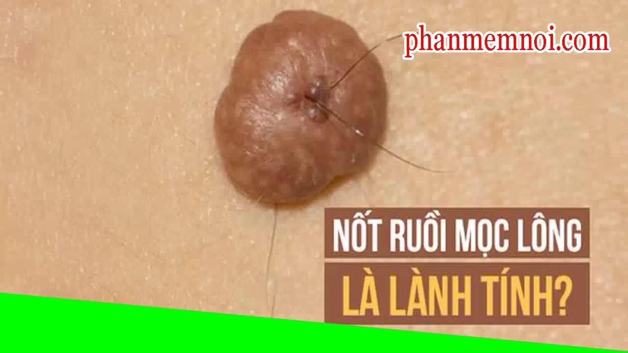 Lông mọc ở nốt ruồi có nguy hiểm