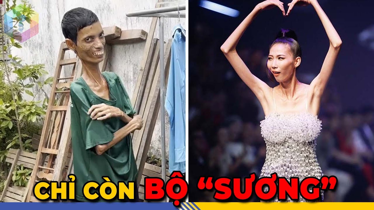 Người gầy tại Việt Nam