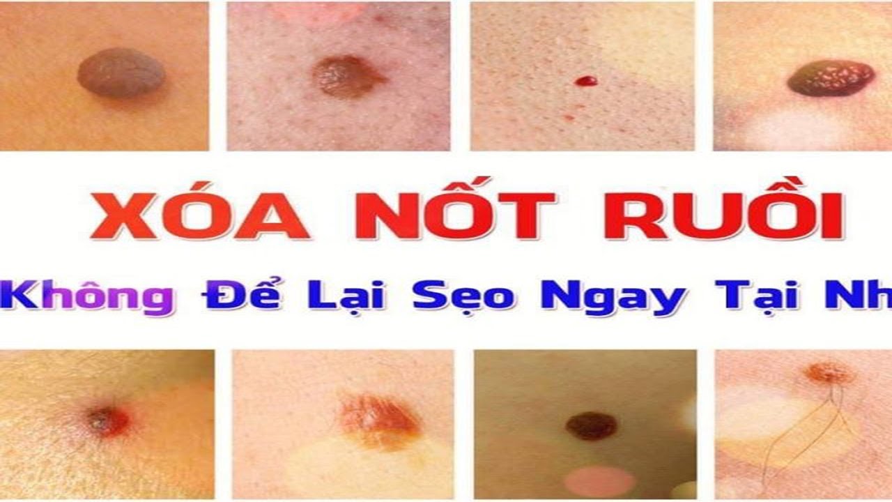 Các vị trí nốt ruồi nên giữ trên mặt