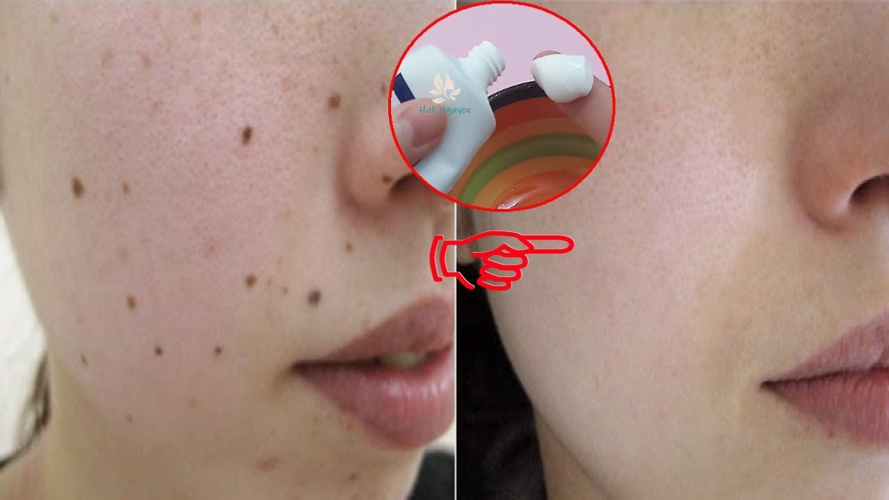 Các vị trí nốt ruồi trên mặt phụ nữ