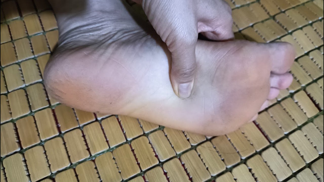 Ngứa gan bàn chân ban đêm