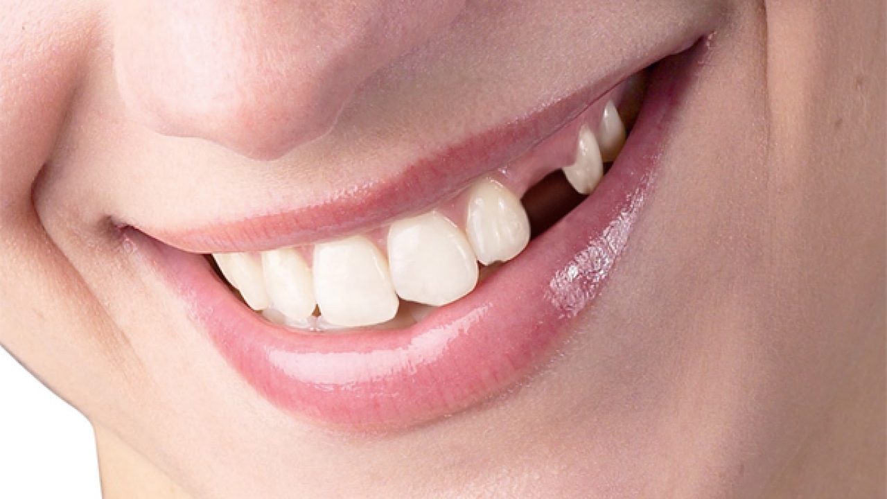 Người nằm ngủ mơ thấy rụng răng trắng