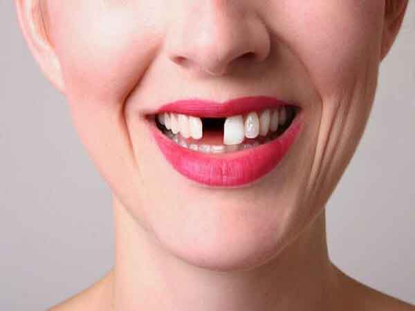 Nằm mơ thấy gãy răng đánh đề con gì chuẩn