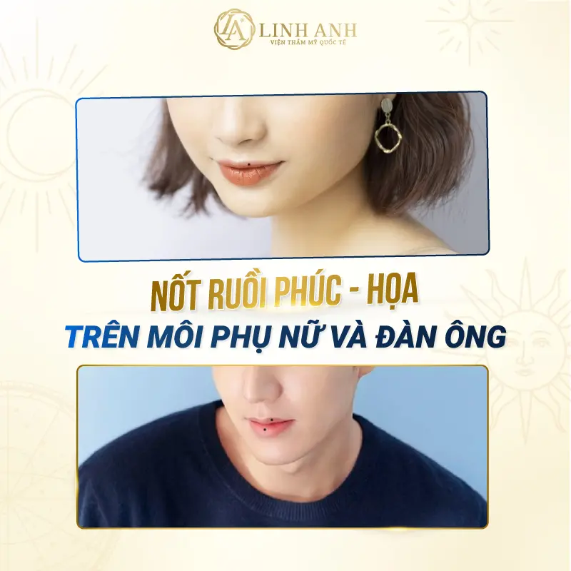 Hình nốt ruồi ở mép miệng trên nam