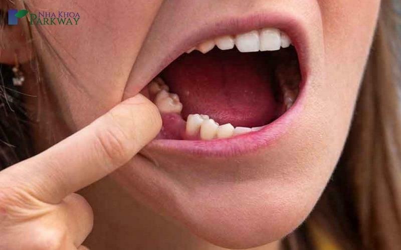 Người nằm mơ thấy rụng răng hàm dưới không chảy máu