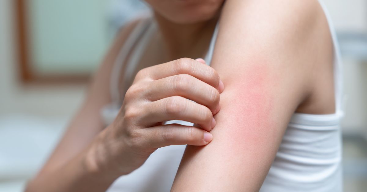 Ngứa tay chân không nổi mẩn