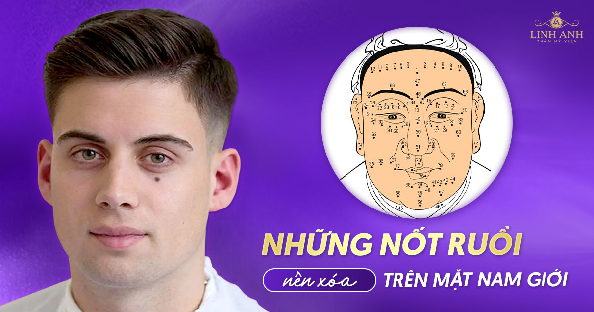 Vị trí nốt ruồi nên xóa ở mặt nam