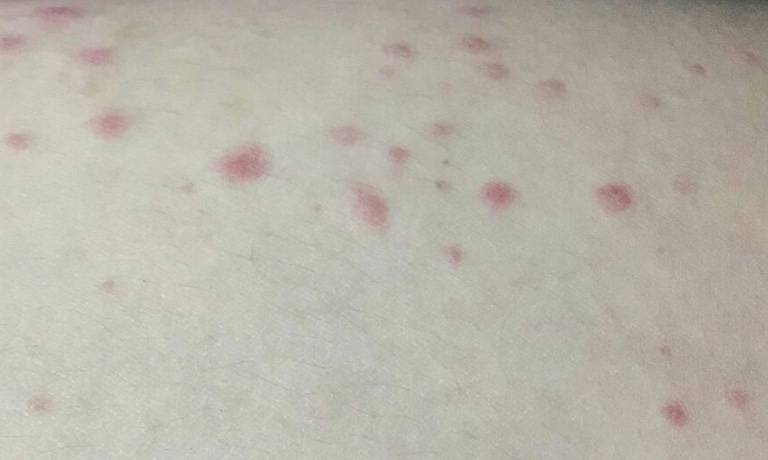 Chấm đỏ nhỏ giống nốt ruồi son