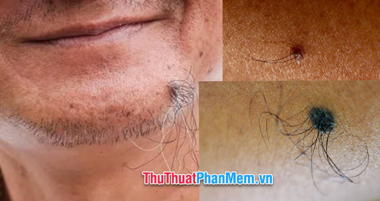 Nốt ruồi có lông ở dưới cằm