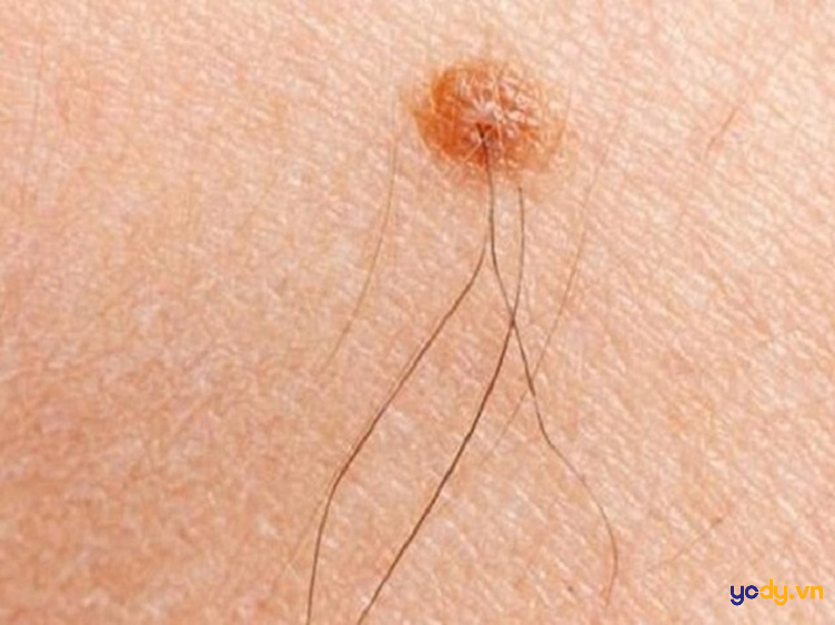 Nốt ruồi dưới cằm góc nghiêng