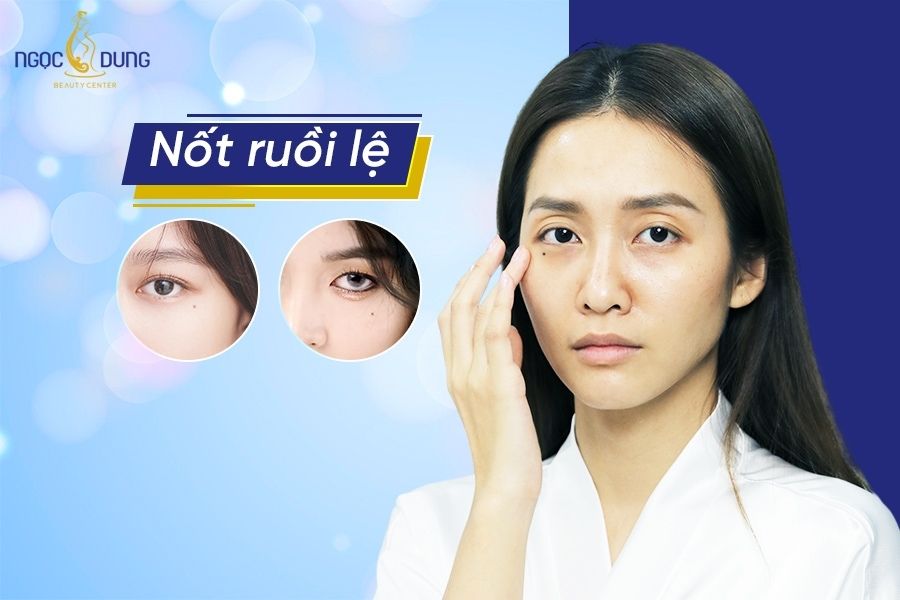 Nốt ruồi lệ đường ở nữ giới