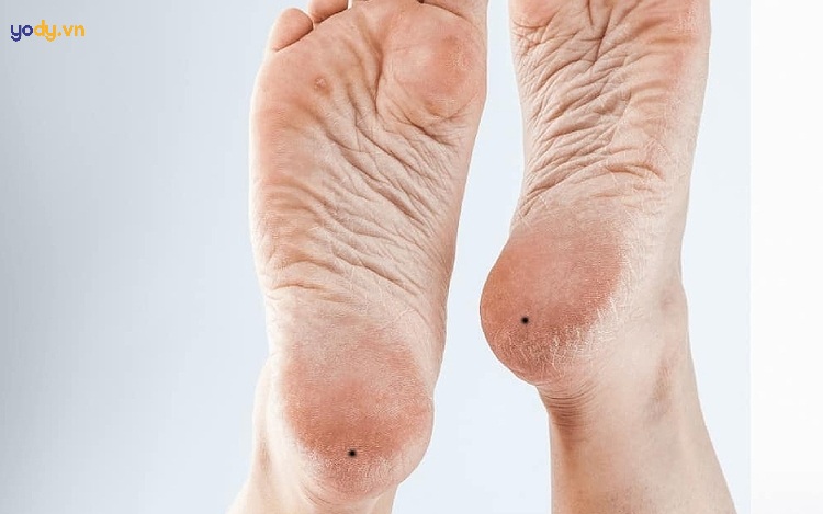 Nốt ruồi ở gót chân dưới lòng bàn chân