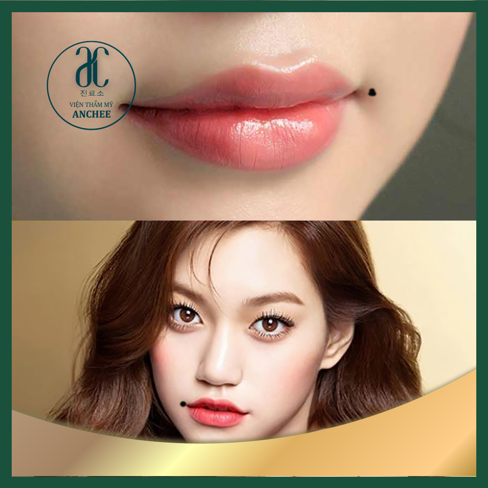 Nốt ruồi ở mép miệng trên bên phải nam