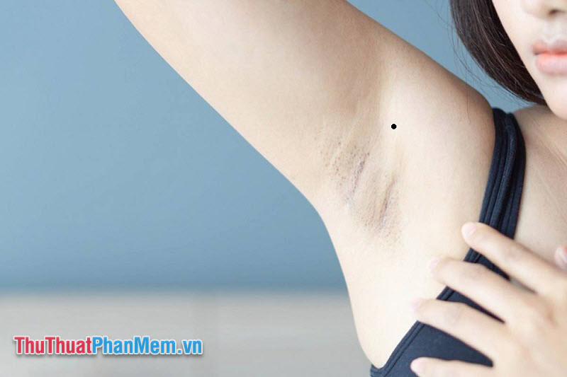 Nốt ruồi ở nách phải trên cơ thể nữ